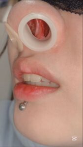 [FC2-PPV-4828912]セプタム拡張で削れた軟骨・鼻腔内部をフラッシュ接写で全公開♡限界サイズのシリコンプラグで鼻の穴を広げる！