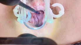 [FC2-PPV-4853829]子宮口への挿入チャレンジ♡ピアスお万個に透明クスコで見やすく！